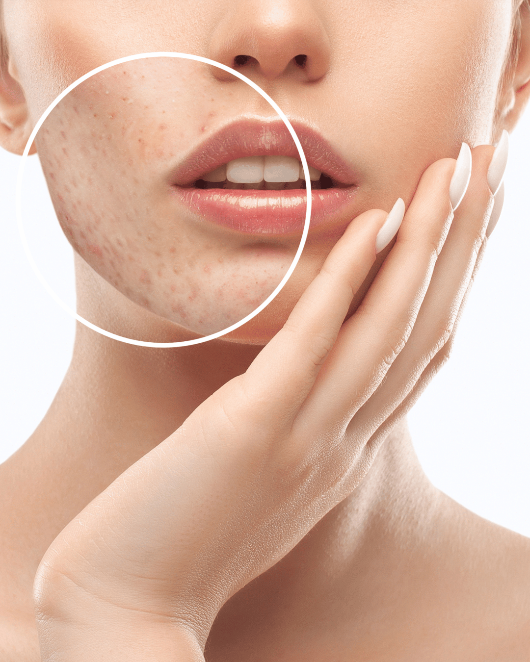 Acne Scar Treatment
