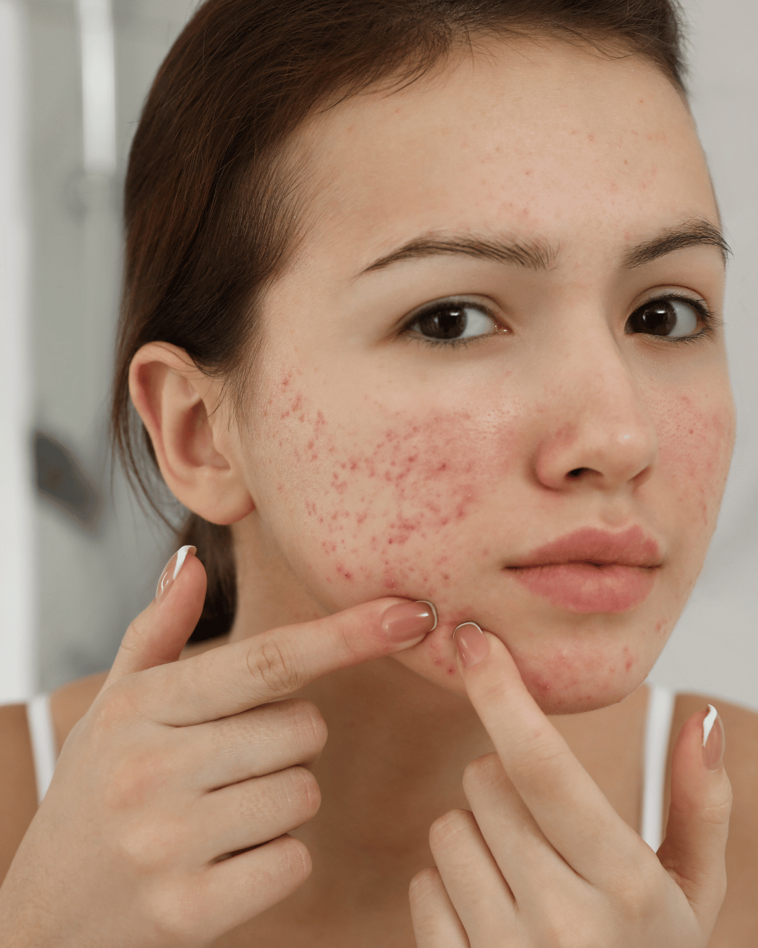 Acne Treatment