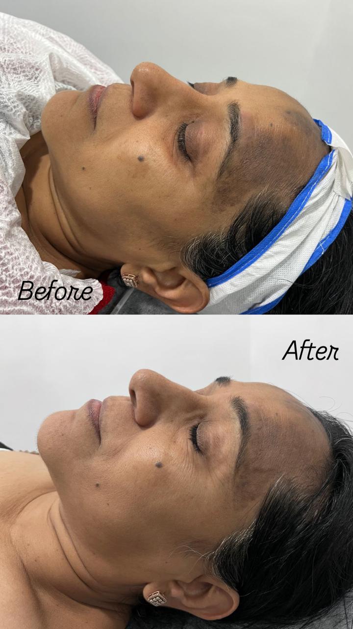 Before and after results at Aesthetic Derm Clinic
