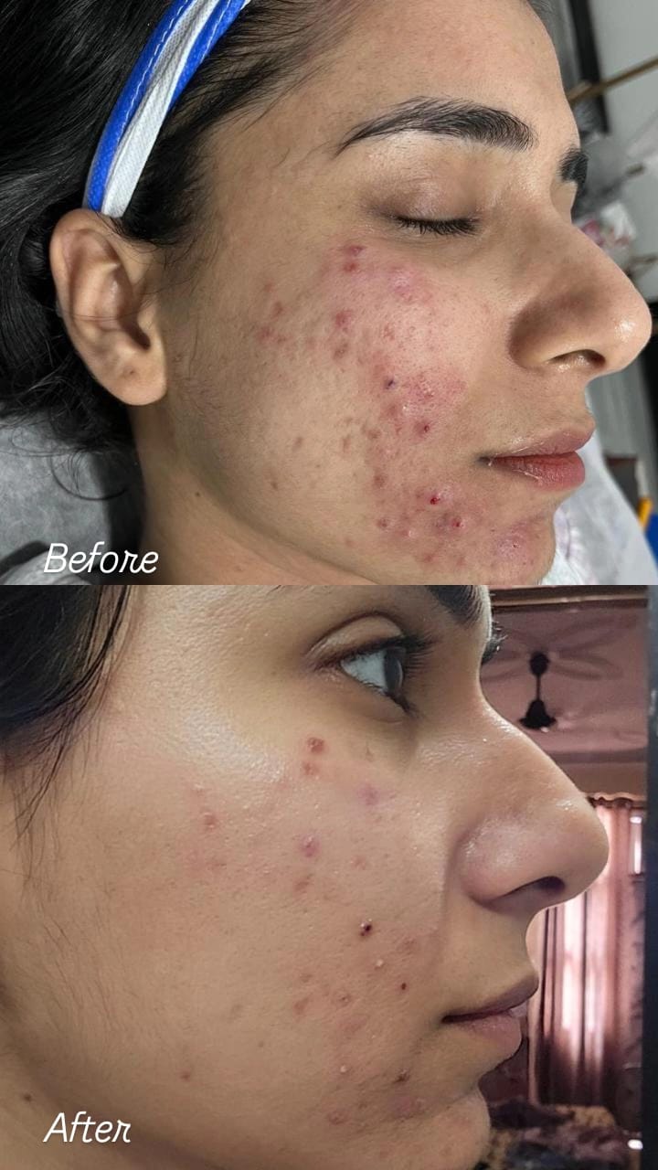 Before and after results at Aesthetic Derm Clinic
