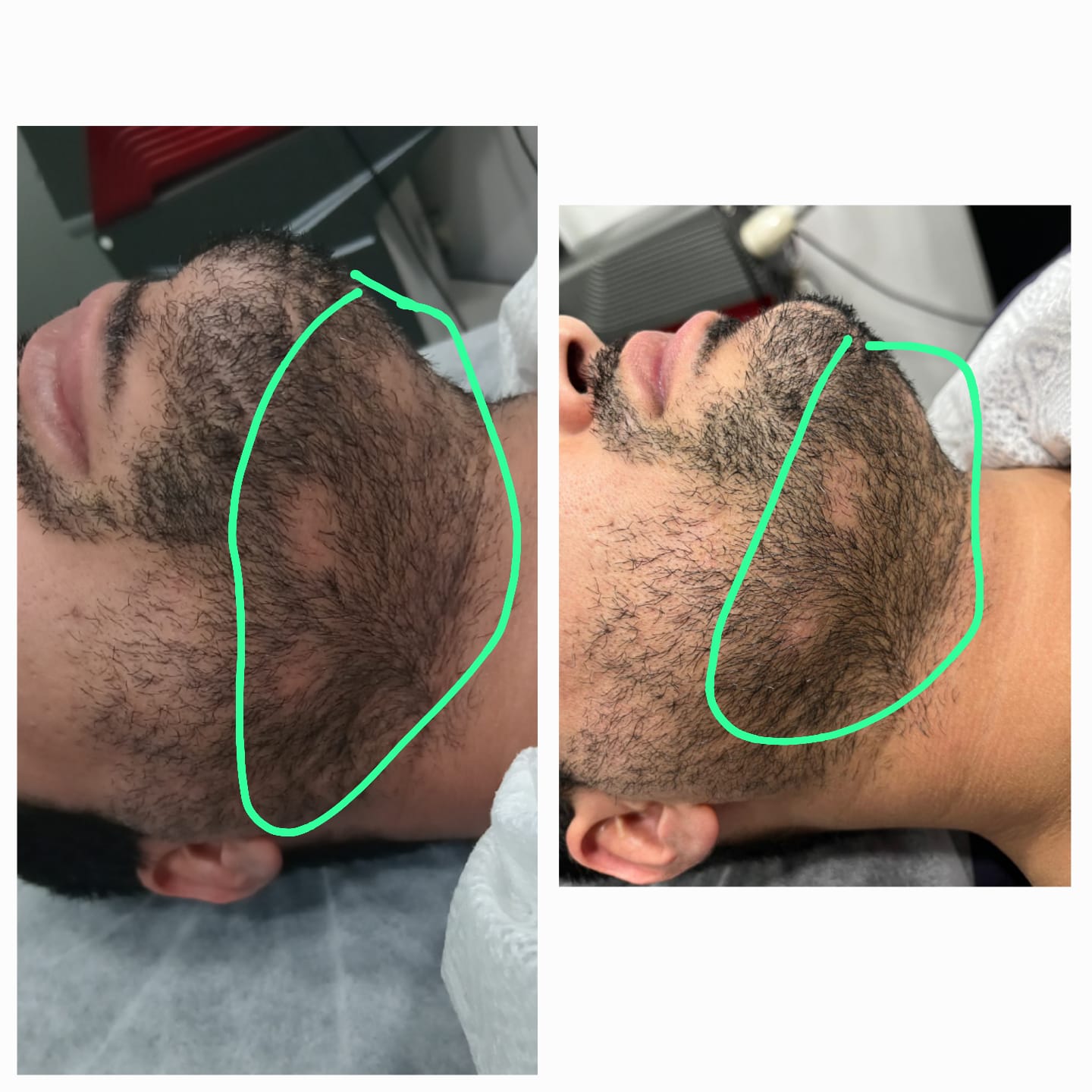 Before and after results at Aesthetic Derm Clinic
