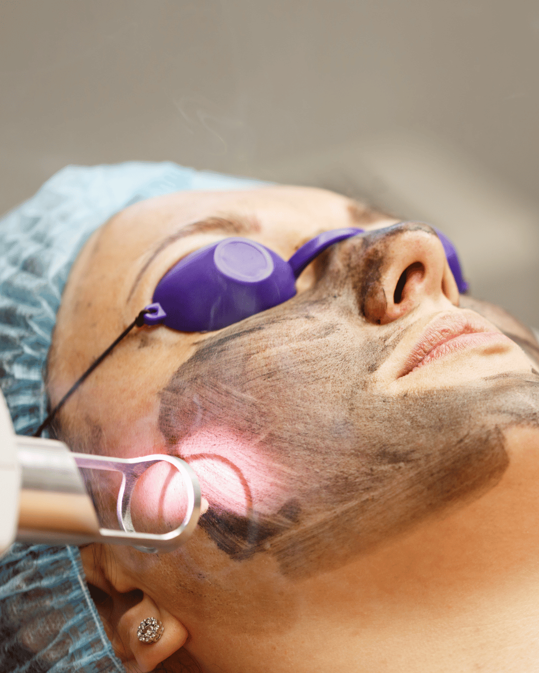 Carbon Facial
