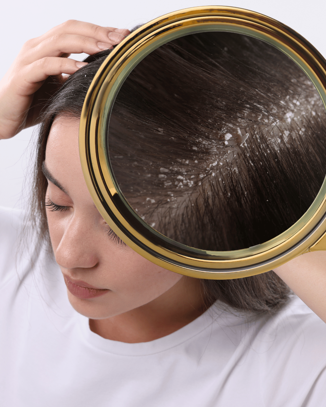 Dandruff Treatment