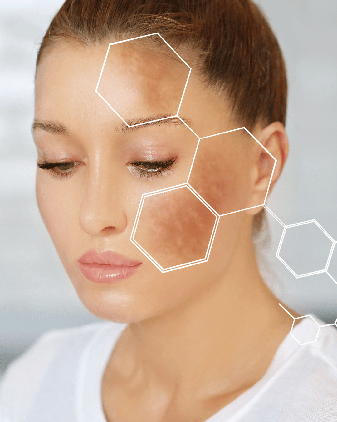 Melasma Treatment
